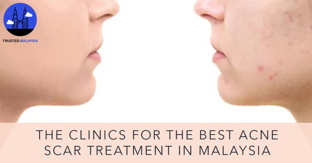 Best Acne Scar Treatment in Malaysia