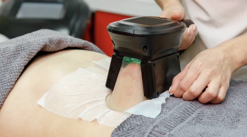 How Does the Procedure of CoolSculpting Go