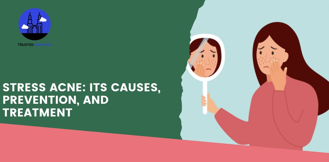 Stress Acne Its Causes, Prevention, and Treatment
