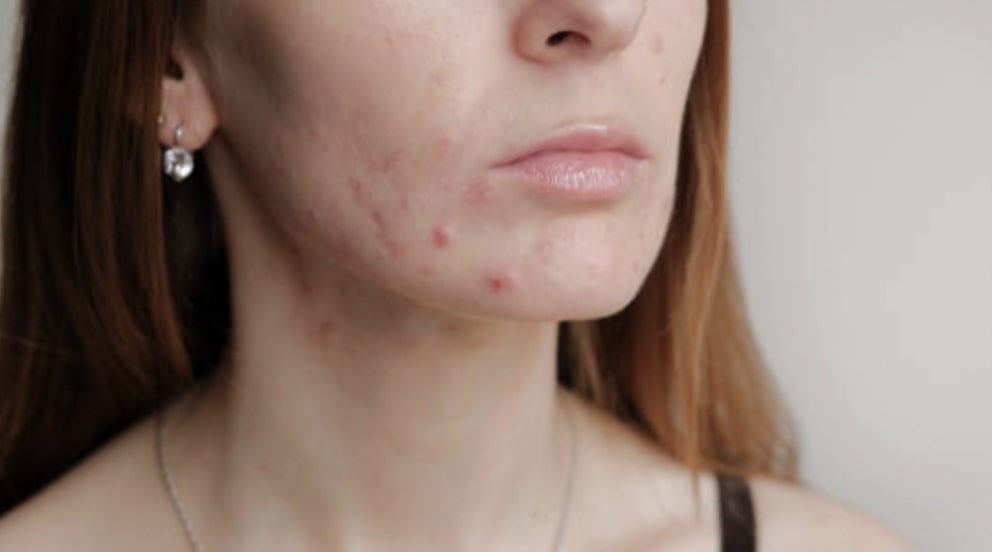 The Cause of Acne Scars