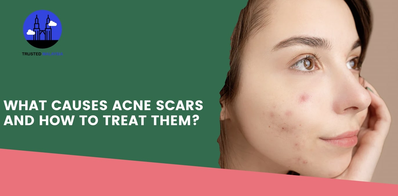 What Causes Acne Scars and How to Treat Them