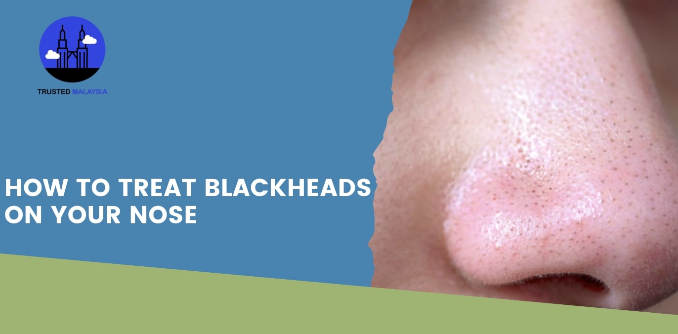 How to Treat Blackheads on Your Nose