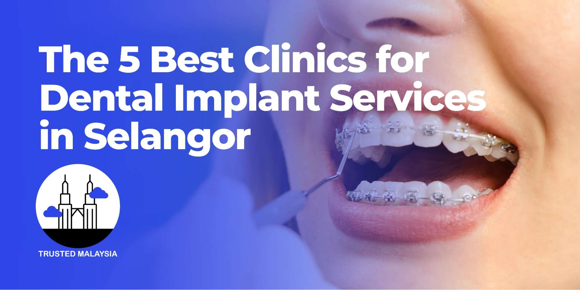 The 5 Best Clinics for Dental Implant Services in Selangor